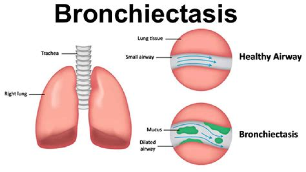 Bronchiectasis: Mechanisms and Imaging Clues of Associated Common and Uncommon Diseases