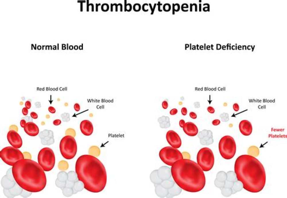 Thrombocytopenia following Pfizer and Moderna SARS‐CoV‐2 vaccination