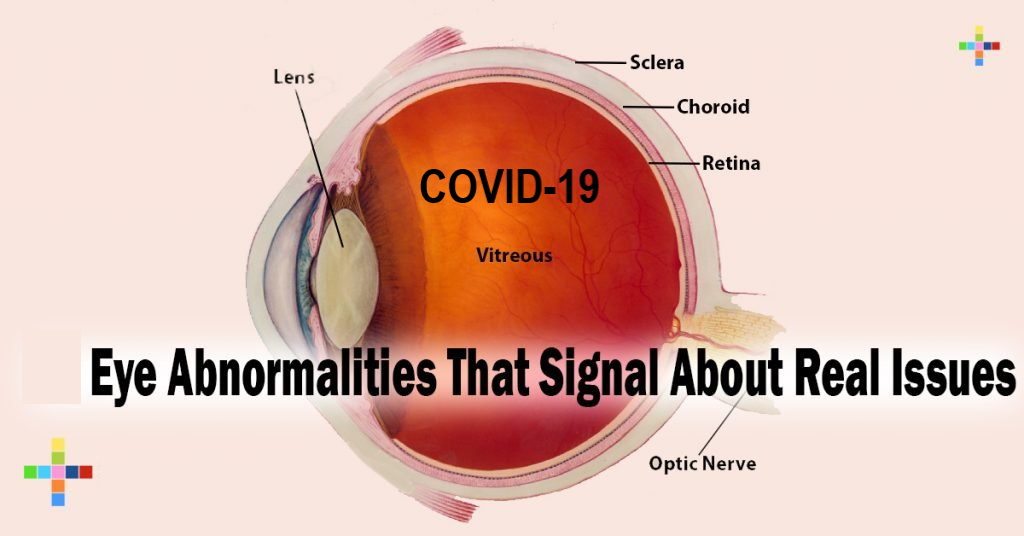 Severe COVID-19 Linked With Changes in Eyes